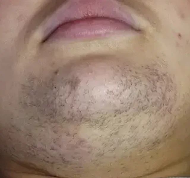 Avant traitement